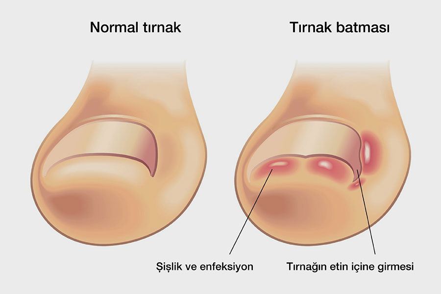 batik-tirnak
